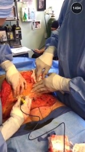 A snap from Dr. Michael Salzhauer's Snapchat (therealdrmiami)