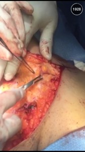 A snap from Dr. Michael Salzhauer's Snapchat (therealdrmiami)