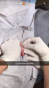 A snap from Dr. Sandra Lee's Snapchat (drpimplepopper)