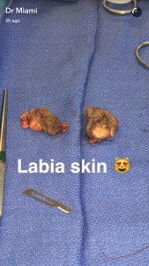 A snap from Dr. Michael Salzhauer's Snapchat (therealdrmiami)